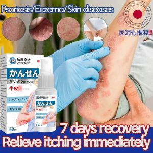 antifungal psoriasis spray Anti itch spray 60ml Spray Japan psoriasis spray quickly relieve itching moisturize and protect the skin