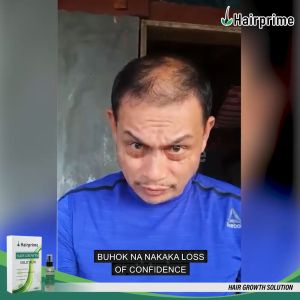 Buy1 Take1 Today: Hairprime Hair Growth Solution Serum Spray & Minoxidil Hair Grower