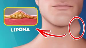 SmileCode Advanced Lipoma & Tumor Reduction Cream for Smooth Skin
