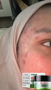 Effective Pimple Remover Cream Soothing Pimple Remover Fades Acne Marks Repairs Acne Pits Shrink Pores 30ml