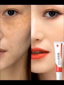 Original Melasma Cream Pekas Remover Collagen Pekas Remover Whitening Freckle Cream Remover Melasma Acne Dark Spot Melanin Pigmentation Moisturizing Skin Care 20g