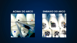 Rotation Wedges Orthodontic I Karet Elastic Rotator Universal Morelli I Karet Rotator