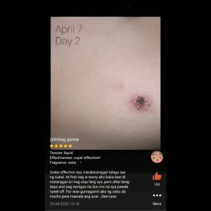 Organic Kasoy Oil by Nature’s Miracle: Wart Remover & Mole Treatment – Genital-Safe Formula