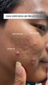 CHALONESE PAKET HEMAT 5 IN 1 (FACIALWASH+SUNSCREEN+3 BRIGHTENINNG CREAM) MEMBANTU MENCERAHKAN WAJAH MELINDUNGI WAJAH DARI PAPARAN SINAR MATAHARI