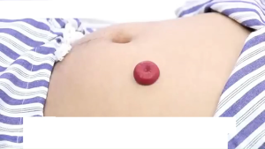 Bột chống loét hậu môn nhân tạo hút ẩm chống kích ứng
