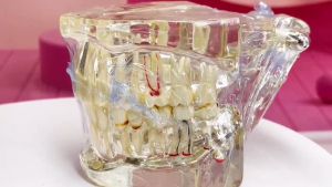 Dental Implant Model Teeth Model Tooth Dentist For Dental Disease Teaching Study Tool