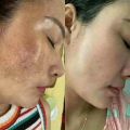 kem jukium Dòng kem trị nám hiệu quả nhất nhật bản. 
