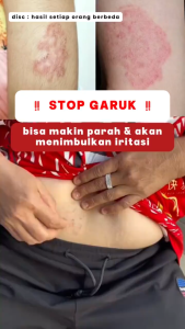 [Taboya Official Store] Taboya Moon Zhang Cream Penghilang Bekas Luka / Flek Hitam / Keloid