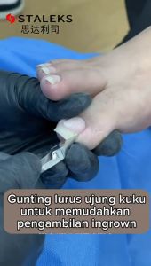 Staleks Ingrown Nail Nipper Expert 61-16mm Gunting Kuku Cantengan