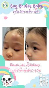 Lynn Organic Bug Bruise Balm 3 in 1 ตัวช่วยที่ทุกบ้านต้องมี ที่สุดของบาล์มลดอักเสบ ตุ่มยุง หัวโน ฟกช้ำ ขีดข่วน รอยดำ ครบจบในหลอดเดียว