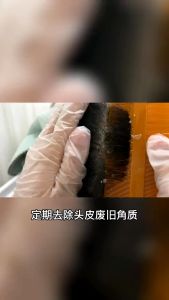 Lược bí chải chấy bằng gỗ bằng nhựa cao cấp lược dầy lược dày chải đầu lược chải chấy -LUMBL