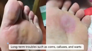Foot Corn Removal Patch Foot Corns/Warts Removal Patch Remove Foot Calluses Skin Tags Warts Invisible Patches Acne Patches Pain Relief Remove Foot Calluses Foot Corns Patch Remove And Soften Cuticles Medical Bandages Foot Care