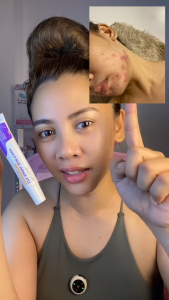20g Azelaic Acid Cream Facial Cream with Hyaluronic Acid and Niacinamide for Sensitive Skin Care CBS-PH