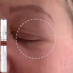 100% Effective Removal of Warts and Moles Original Cream Wart Removal Liquid Pen Granulation Skin Flat and Smooth Skin and Removing Warts Care Facial Skin Tag Removal Pen Foot Corn Plantar Wart Papillomas Removal 3ml