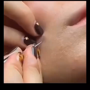 Bộ Lấy Nhân Mụn 8 Món / 5 Món Chất Liệu Inox Bền Bỉ Bộ Nặn Mụn Có Nhíp Dễ Dàng Lấy Mụn Ẩn Mụn Cám