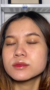ACNEMED BLEMISH SPOT: Solusi Perawatan Kulit Wajah
