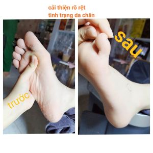 thảo dược chống nức nẻ gót chânchống tróc da chân BẢO LINH