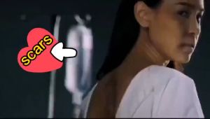 EELHOE Surgical Scar Repair Cream: Effective Remover for Pimples & Acne Scars