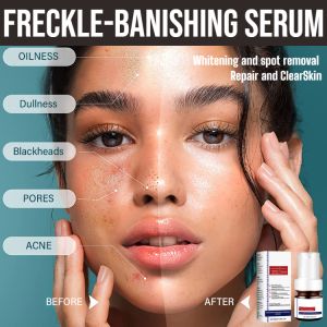 Freckle-Banishing Serum Dark Spot Correction Serum Moisturizer Facial Essence Face Repair And Cleanse Dark Spots