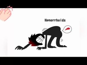 痔疮膏 除痔疮软膏 断根 止痛 痔疮软膏 消肉球 hemorrhoids itching hemorrhoid ointment 内外痔 愈合痔 Hemorrhoid removal cream relief the pain for men and women