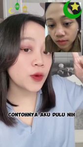 CHALONESE Cream Wajah BPOM Penghilang BINTIK HITAM FRECKLE REMOVAL Efektif 20gr