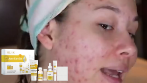 EELHOE 5-in-1 Acne Treatment Skincare Set Pimple Acne Removal Repair Kit Face Body Back Acne Cream Gel Patch Set