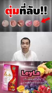 หูดติ่งเล็กๆหูดในที่ลับตุ่มที่เกิดขึ้นโดยไม่ทราบสาเหตุ สมุนไพรดูเเละภายในหนองใน