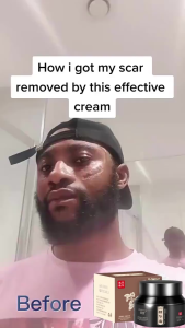 Top Rated Scar Removal Cream! Ideal for Scar Care Keloids Treatment and Acne Care. This Skin Care Cream is effective on various types of scars like Falls Surgery Marks Burns Cuts Scratches and Insect Bites 50g Cream