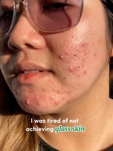 NUVI Super Potent Skin Regenerating Bundle - Dark spots Remover Pimple Marks Remover Blemish Remover Glass Skin Set