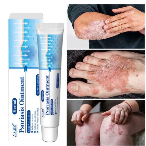 Psoriasis Antibacterial Ointment Topical Skin Ointment Inhibit Bacteria Relieve Itching Dermatitis Eczema Itchy Skin
