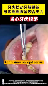 CROENT Pasti Gigi Pemisah Gigi Melindungi Gigi Memperbaiki Gigi Longgar dan Gusi VP082