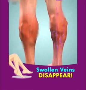 Varicose Veins Treatment Cream Keep your legs beautiful Varicose veins 50g Promote blood circulation and relieve swelling of veins Varicose veins cream spider veins pain varicose veins cream