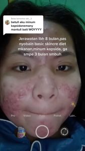 Obat Pembersih Darah Kotor Kembang Bulan Kapsul Jerawat Bisul Paling Ampuh Brutusan Kapsida Penghilang Gatal Kulit Seluruh Badan Pria Dan Wanita