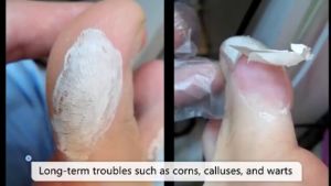 100% Effective Corns & Wart Removal Patch: Foot Care Solutions