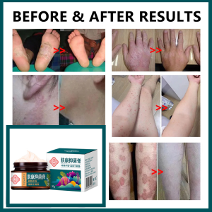 Ready stock ubat gatal kulit ubat gatal eczema cream krim gatal ubat gatal kemaluan antifungal cream psoriasis Krim gatal celah kang Antibacterial cream Natural Ingredients30G抑菌止痒膏