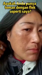 Youbuy Cream Menyamarkan Noda Hitam Di Wajah Mengurangi Flek Hitam Dan Melasma