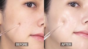 Bộ đôi xóa mờ nám sạm phục hồi làn da giãn mao mạch và dưỡng da sáng đều màu Skinmd Pure Whitenol Serum và Cream Intensive
