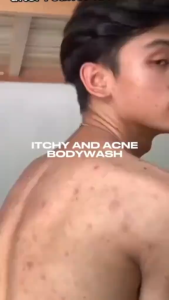 QUARXERY Anti-Mite Antibacterial Body Wash 250ml + Rapid Acne Gel 15g – Eliminates Mites Fights Acne Soothes Inflammation