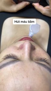 Lẻ 1 ống Nhựa Hút Máu Bầm Ống Hút Mụn Mủ Cho Spa/Thẩm Mỹ Viện