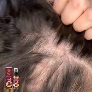 【Hot Sale】Ouhoe Onion Hair Dense Essential Oil – Onion Essence Hair Growth Oil Strong & Stable Moisturizing Hair Care Fast Growth & Anti Hair Loss for Women & Men | In Stock | Fast Shipping