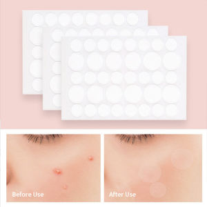 120/180 Patches Acne Pimple Patch Stickers Acne Pimple Remover Tool Absorb Pus And Oil Acne Patch Skin Care As Protective Cover
