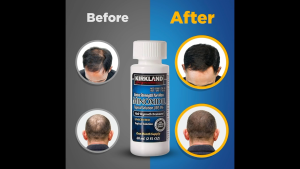 2 MINOXIDIL WITH 2 PIPETTES