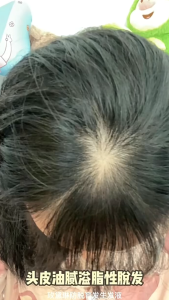 Hair Growth Essence Hair Care Deeply Nourishes The Scalp Rapidly Promotes Hair Growth 生发精华