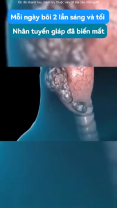 Kem Tan Rã Tuyến Giáp SENJOKO - Hỗ Trợ Kháng Viêm Kháng Khuẩn Giảm Đau Hiệu Quả