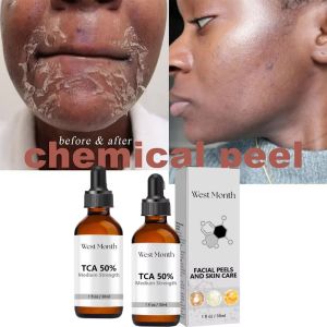EELHOE | Acid Peeling Serum Chemical Exfoliant Peel For Remove Face Dark Skin Spots Whiten Lighten Melanin Peeling Solution Skin Peel