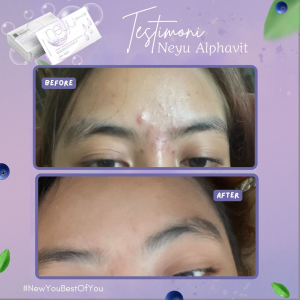 NEYU Alphavit Sabun Pemutih Seluruh Badan dan Muka Glowing Penghilang Flek Hitam Membandel Anti Jerawat Pori-Pori BPOM\nNEYU Sabun Penghilang Jerawat dan Flek Hitam Membandel Ampuh BPOM