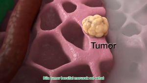 Galrida Bharata 500 Gram: Obat Kanker Payudara, Serviks & Rahim Paling Ampuh