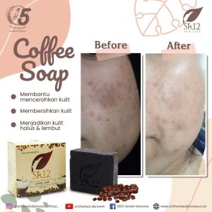 SABUN PLEK HITAM DAN BEKAS JERAWAT