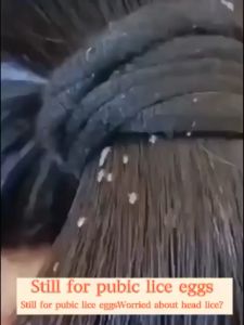 anti lice shampoo anti dandruff shampoo children shampoo Effective removal Head lice Pubic lice and lice eggs Oil Control Dandruff Shampoo Anti dandruff shampoo Lice Shampoo Deep cleansing of the scalp pubic lice and nit eggs do not recur