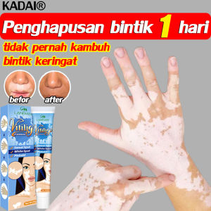 1 hari sembuh KADAI Salep Vitiligo 100% menghilangkan Menghambat Pertumbuhan Kulit Putih mengaktifkan melanin Meratakan Warna Kulit Untuk tubuh dan wajah formula jamu Tidak melukai kulit(vitiligo cream obat salep vitiligo vitiligo obat)